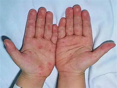 过敏了?€么止???